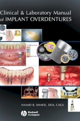Hamid R. Shafie - Clinical and Laboratory Manual of Implant Overdentures - 9780813808819 - V9780813808819