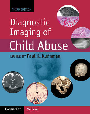 Paul Kleinman - Diagnostic Imaging of Child Abuse - 9781107010536 - V9781107010536