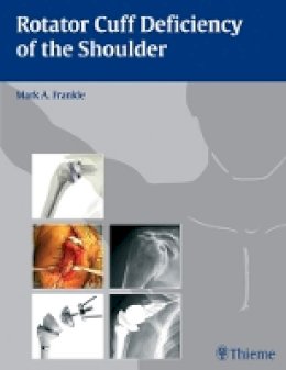 Frankle - Rotator Cuff Deficiency of the Shoulder - 9781588905062 - V9781588905062