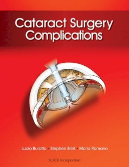 Lucio Buratto - Cataract Surgery Complications - 9781617116087 - V9781617116087