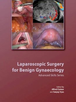 Alfred Cutner (Ed.) - Laparoscopic Surgery for Benign Gynaecology: Advanced Skills Series (Royal College of Obstetricians and Gynaecologists Study Group) - 9781906985318 - V9781906985318