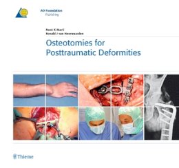 Ronald J. Van Heerwaarden - Osteotomies for Posttraumatic Deformities - 9783131486714 - V9783131486714