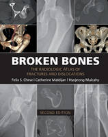 Felix S. Chew - Broken Bones: The Radiologic Atlas of Fractures and Dislocations - 9781107499232 - V9781107499232